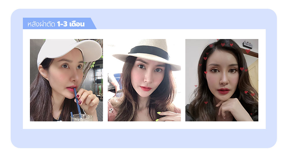 จมูกเรียวพุ่งรับกับใบหน้าตัวเอง แนะนำ โรงพยาบาลศัลยกรรมมาร์เบิ้ล MARBLE PLASTIC SURGERY