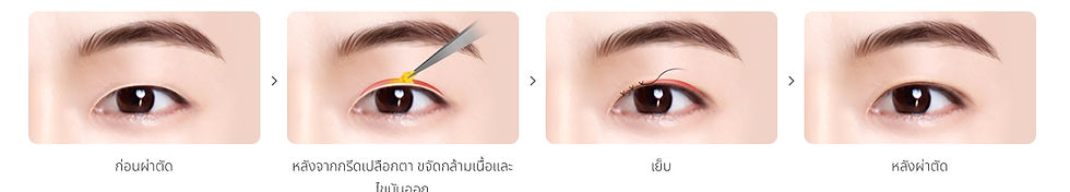 | ศัลยกรรมตาสองชั้นหลบในของผู้ชาย แบบกรีด