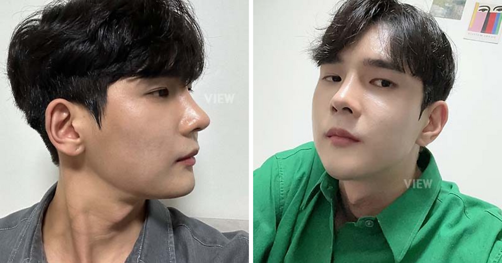 REVIEW โครงหน้า 3 จุด ผู้ชาย โรงพยาบาลวิว VIEW Plastic Surgery