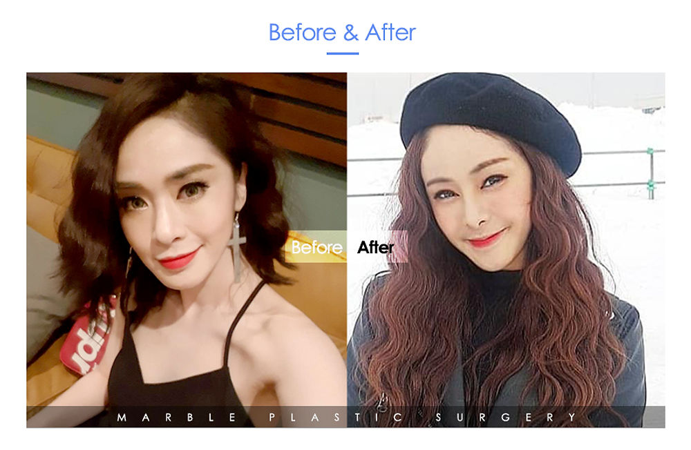 รีวิว อยากสวย! เพิ่มความมั่นใจให้ตัวเอง แนะนำ โรงพยาบาลศัลยกรรมมาร์เบิ้ล MARBLE PLASTIC SURGERY