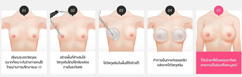 | วิธีการผ่าตัดเสริมหน้าอก