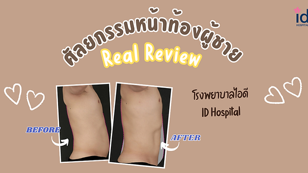 รีวิวศัลยกรรมหน้าท้องผู้ชาย ที่โรงพยาบาลไอดี ID Hospital