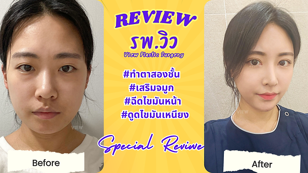 ทำตาสองชั้น / เสริมจมูก / ฉีดไขมันหน้า / ดูดไขมันเหนียง โรงพยาบาลวิว VIEW Plastic Surgery