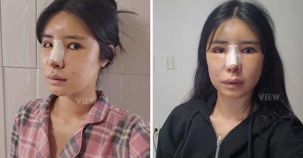 โครงหน้า 3 จุด / แก้ตา / แก้จมูก / ฉีดไขมันหน้า โรงพยาบาลวิว VIEW Plastic Surgery