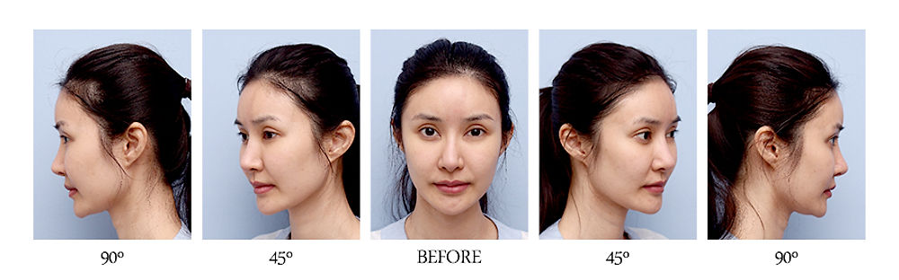 จมูกเรียวพุ่งรับกับใบหน้าตัวเอง แนะนำ โรงพยาบาลศัลยกรรมมาร์เบิ้ล MARBLE PLASTIC SURGERY