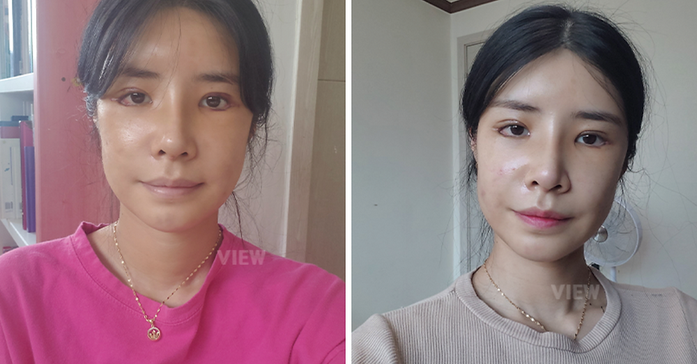 โครงหน้า 3 จุด / แก้ตา / แก้จมูก / ฉีดไขมันหน้า โรงพยาบาลวิว VIEW Plastic Surgery