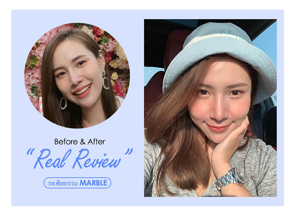 รีวิว สวยขึ้นจนคนทัก! แนะนำโรงพยาบาลศัลยกรรมมาร์เบิ้ล MARBLE PLASTIC SURGERY
