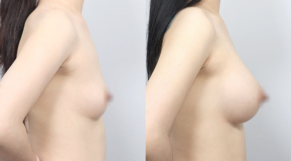 รีวิวการศัลยกรรมหน้าอกแต่ละแบบของโรงพยาบาลศัลยกรรมเอบี (AB Plastic Surgery)