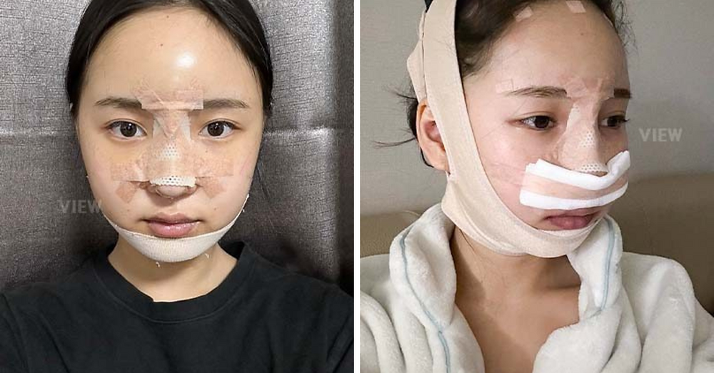 REVIEW โครงหน้า 3 จุด / แก้จมูก / ฉีดไขมันหน้า โรงพยาบาลวิว VIEW Plastic Surgery