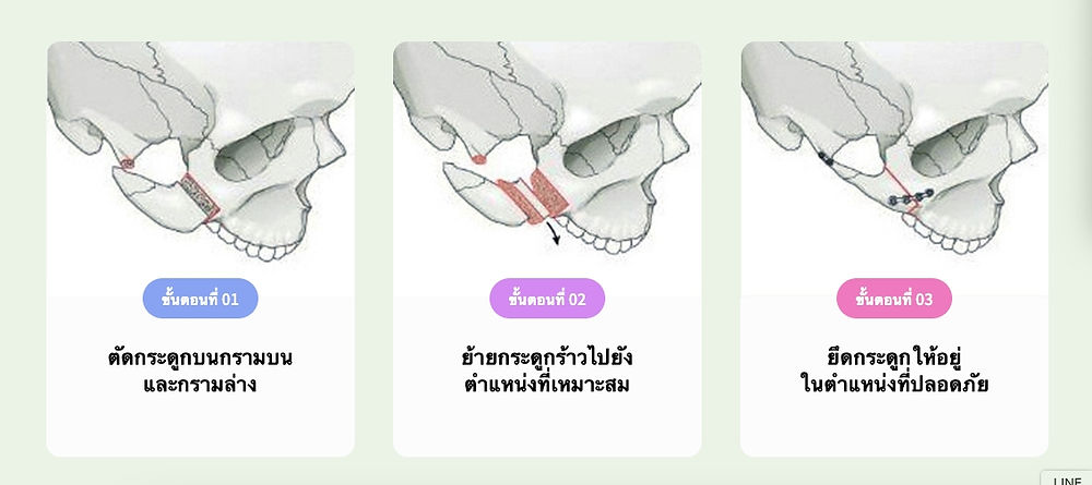 ศัลยกรรมขากรรไกร โรงพยาบาลวอนจิน Wonjin Plastic Surgery
