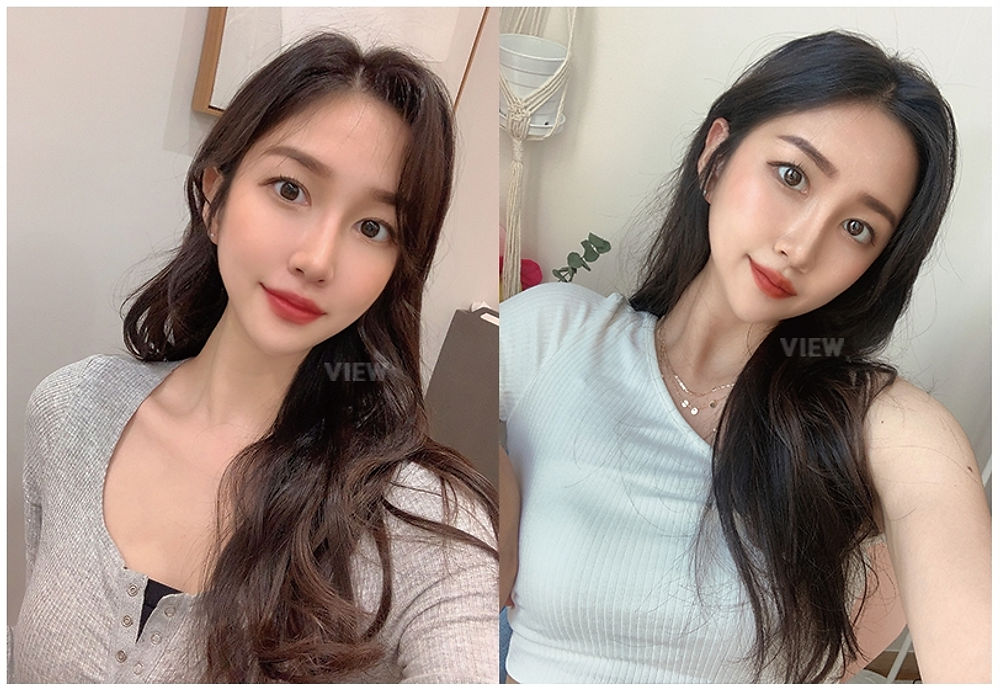 โครงหน้า 3 จุด / ร้อยไหม / ฉีดไขมันหน้า / ดูดไขมันเหนียง ศัลยกรรมปรับโครงหน้าที่ โรงพยาบาลวิว VIEW Plastic Surgery