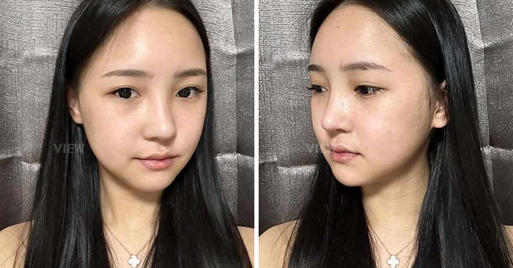 REVIEW โครงหน้า 3 จุด / แก้จมูก / ฉีดไขมันหน้า โรงพยาบาลวิว VIEW Plastic Surgery