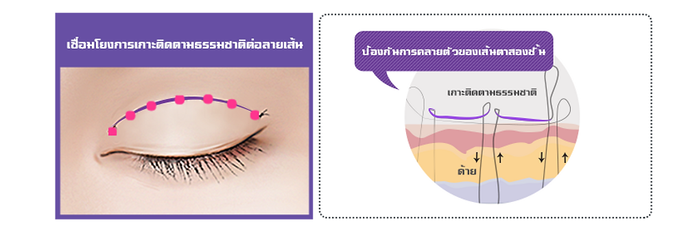 | ข้อดีของวิธีเย็บ เซเว่นล็อค