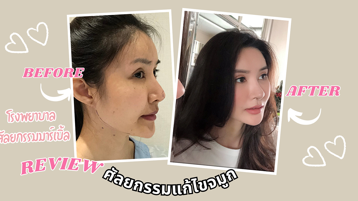 รีวิว จมูกเรียวพุ่งรับกับใบหน้าตัวเอง แนะนำ โรงพยาบาลศัลยกรรมมาร์เบิ้ล MARBLE PLASTIC SURGERY