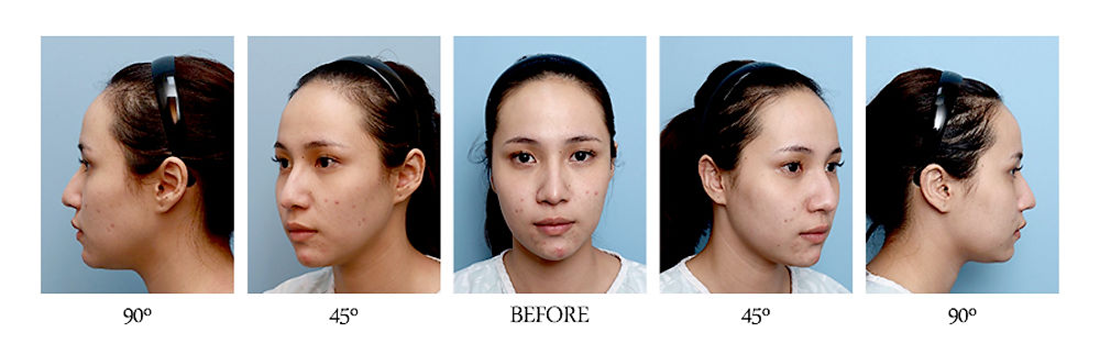 รีวิว สวยขึ้นจนคนทัก! แนะนำโรงพยาบาลศัลยกรรมมาร์เบิ้ล MARBLE PLASTIC SURGERY