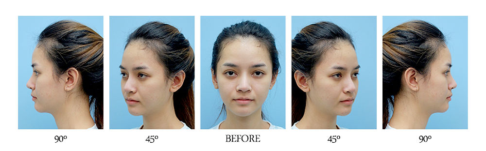 รีวิว หน้าละมุม ลูกสาว โรงพยาบาลศัลยกรรมมาร์เบิ้ล MARBLE PLASTIC SURGERY