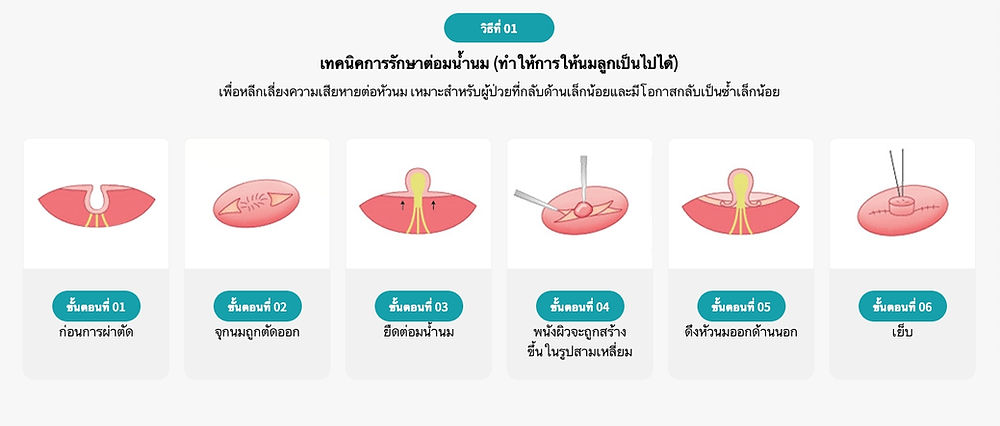 ศัลยกรรมหัวนม โรงพยาบาลวอนจิน Wonjin Plastic Surgery