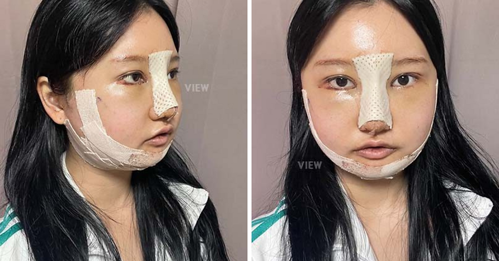 โครงหน้า 3 จุด / เสริมจมูก / ทำตาสองชั้น โรงพยาบาลวิว VIEW Plastic Surgery