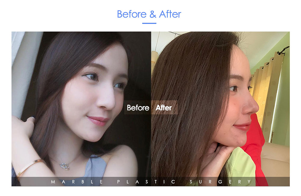 รีวิว สวยขึ้นจนคนทัก! แนะนำโรงพยาบาลศัลยกรรมมาร์เบิ้ล MARBLE PLASTIC SURGERY