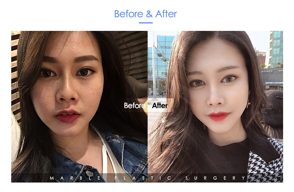 จมูกสวย เข้ากับใบหน้า แนะนำโรงพยาบาลศัลยกรรมมาร์เบิ้ล MARBLE PLASTIC SURGERY