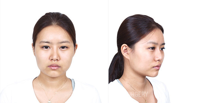 รีวิวสุดปัง โครงหน้า จมูก ปลูกถ่ายไขมัน โรงพยาบาลศัลยกรรมบราวน์ ( Braun Plastic Surgery )