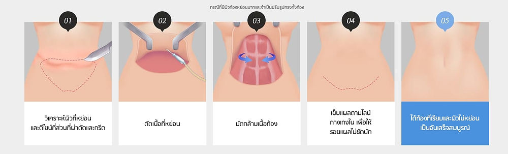 | ศัลยกรรมตกแต่งหน้าท้องธรรมดา
