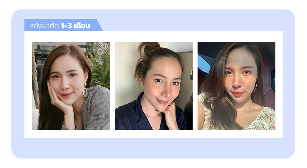รีวิว สวยขึ้นจนคนทัก! แนะนำโรงพยาบาลศัลยกรรมมาร์เบิ้ล MARBLE PLASTIC SURGERY