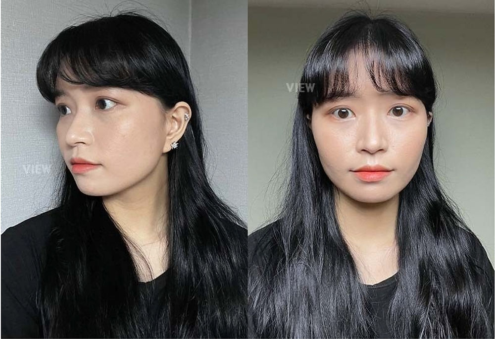 โครงหน้า 3 จุด / ศัลยกรรมจมูก โรงพยาบาลวิว VIEW Plastic Surgery