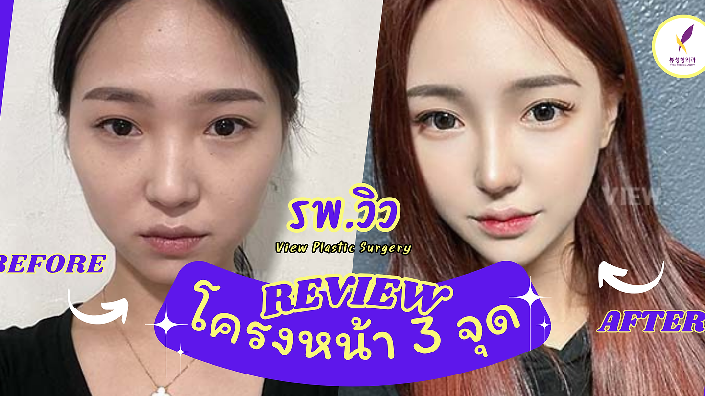 REVIEW โครงหน้า 3 จุด / แก้จมูก / ฉีดไขมันหน้า โรงพยาบาลวิว VIEW Plastic Surgery