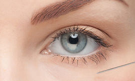 Preenchimento para olheiras fundas Bruwen Acupuntura e estética em Taboão da Serra