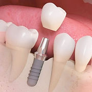 implante-dental-vs-puente-dental.jpg