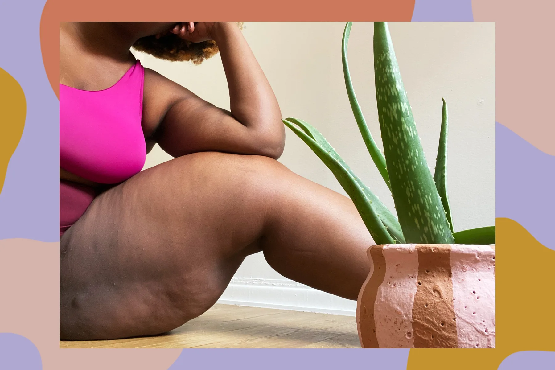 Thigh-Hyperpigmentation.webp