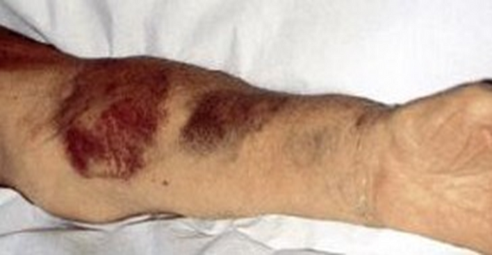 The Vacuderm: the solution to difficult cannulations