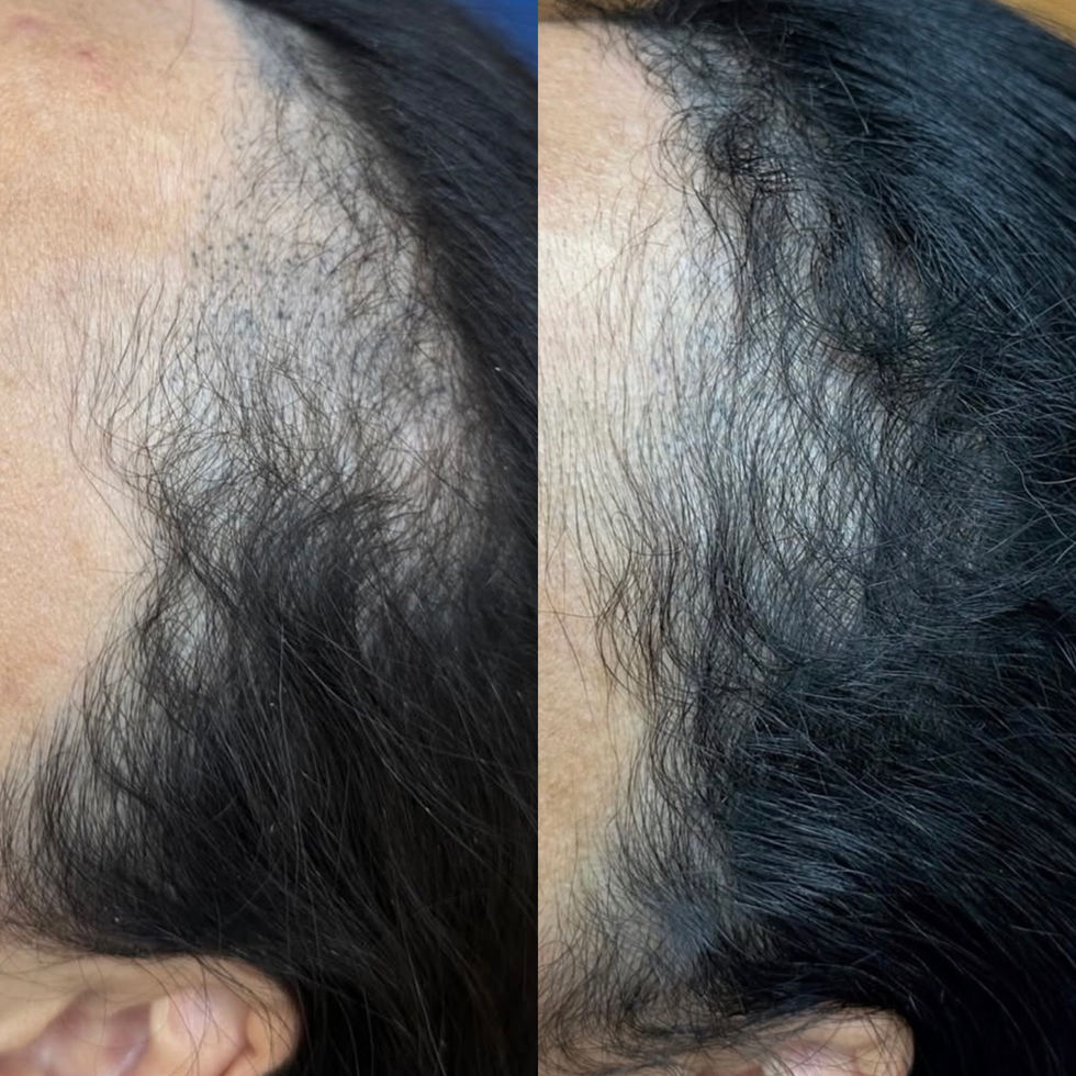 Hair Line density