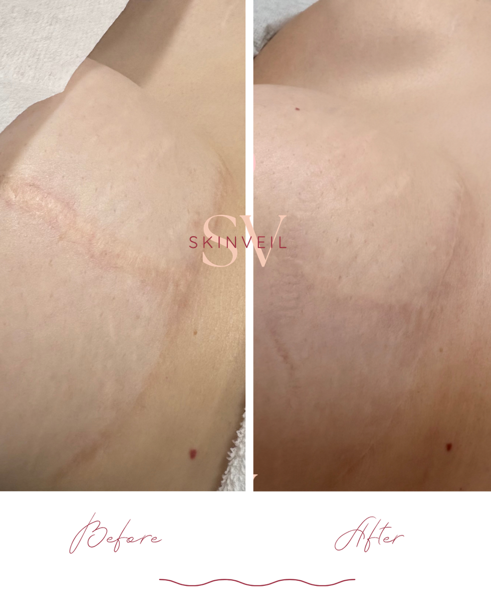 inkless scar