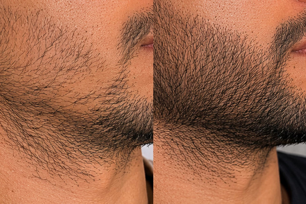 Beard density