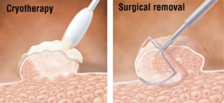 genital warts treatment malaysia