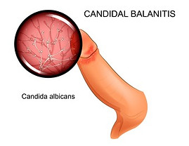 Balanitis