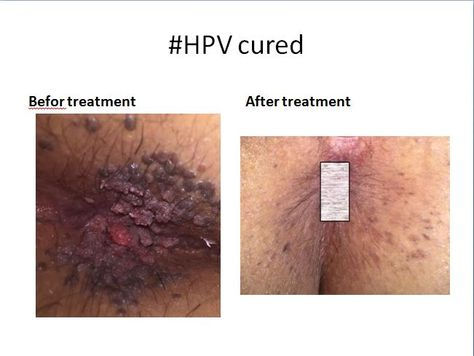 Laser HPV Removal