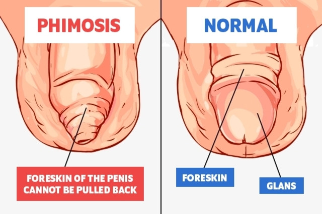 PHIMOSIS