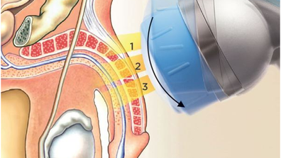 Extracorporeal Shockwave Therapy