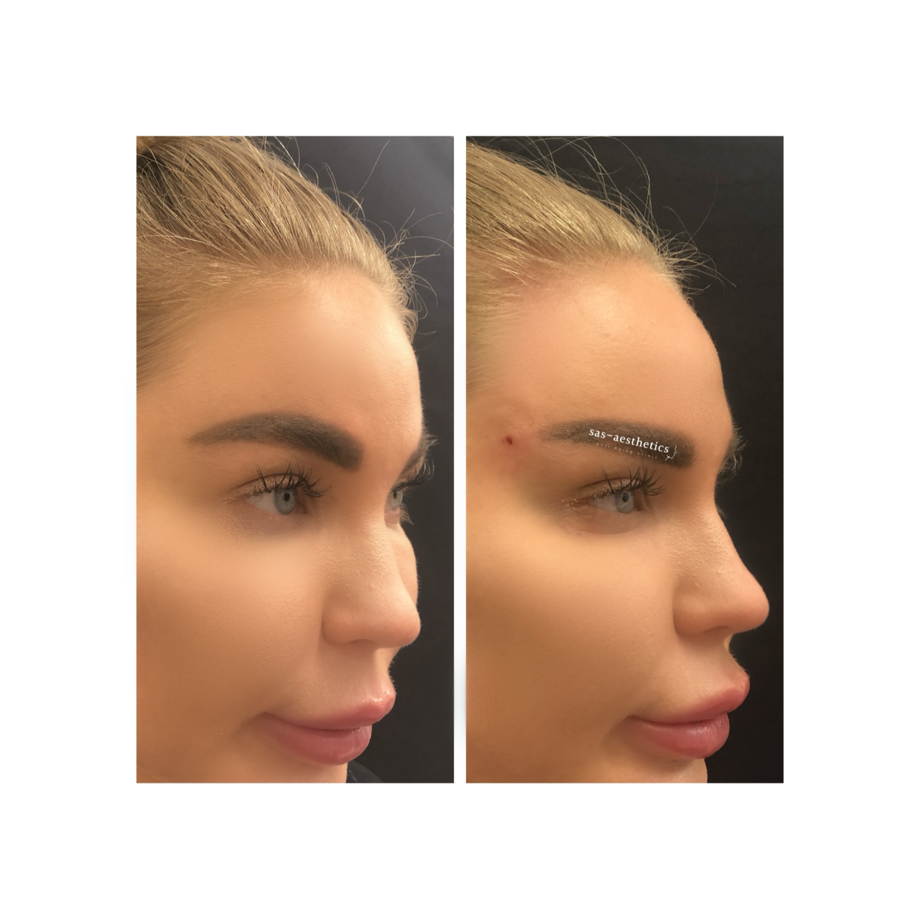 Fox Eyes Thread Lift Harley Street Dr M Saleki Fox Eyes London