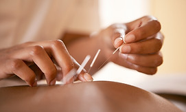 Acupuncture