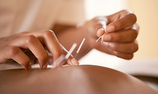 Acupuncture The Hague