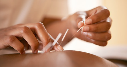 Acupuncture