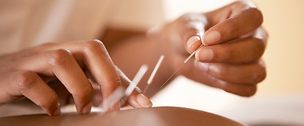 Acupuncture needles being inserted
