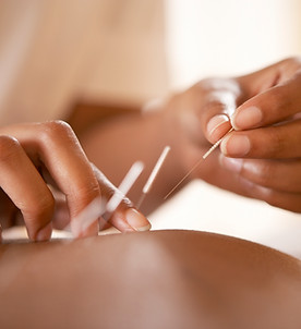 Acupuncture