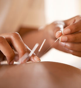 Acupuncture