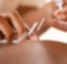 Acupuncture