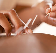 Acupuncture